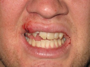 Teeth and Mouth Injuries