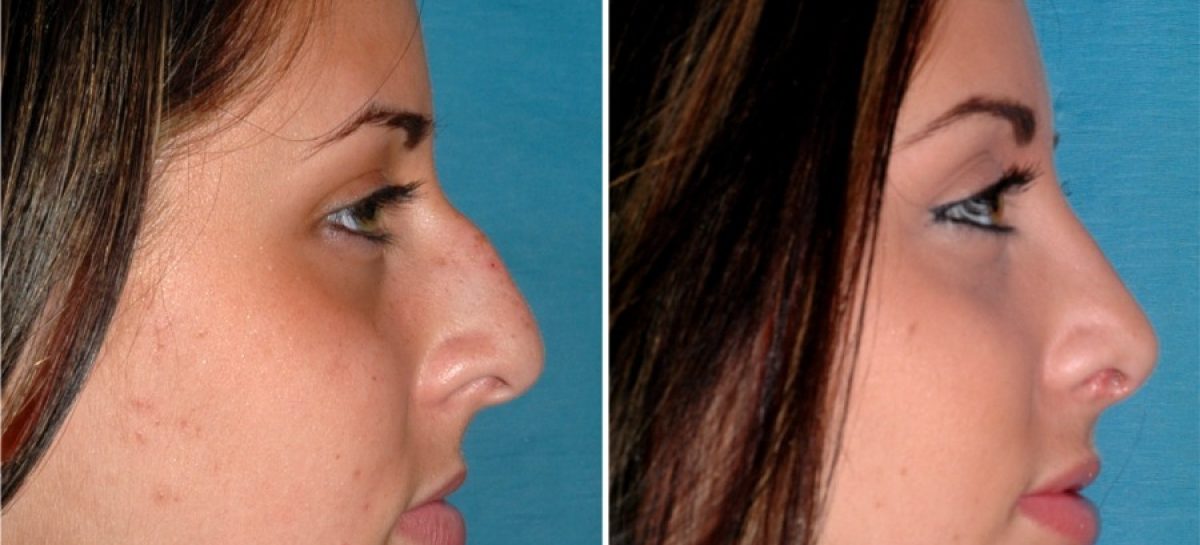 Things involved in the rhinoplasty procedure