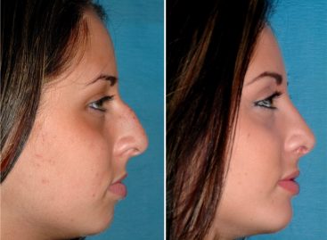 Things involved in the rhinoplasty procedure