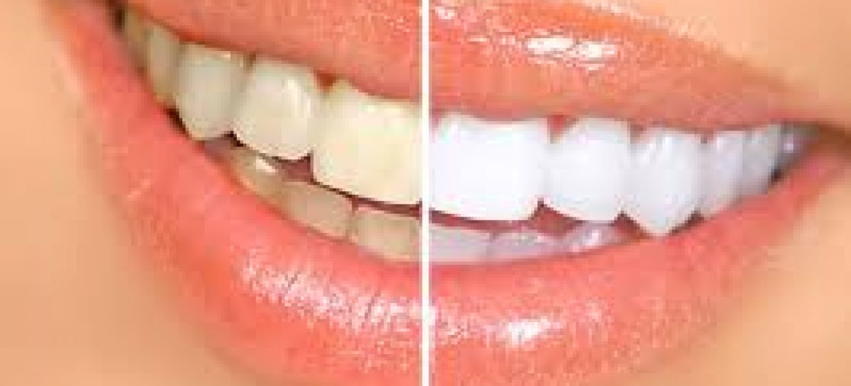 Natural ways to treat yellow teeth successfully