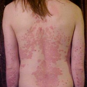 Psoriasis