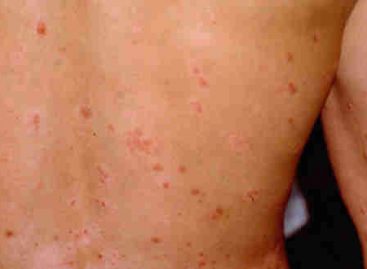 The most useful home remedies for psoriasis