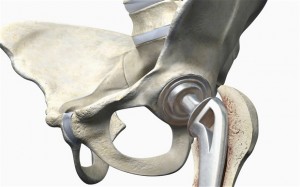 Hip Replacement1