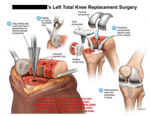 Knee Arthroplasty Surgery