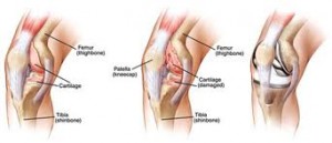 Knee Arthroplasty Surgery1