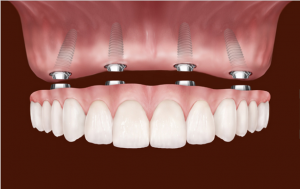 Dental Implants