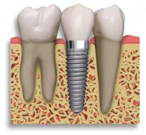 Dental Implants1