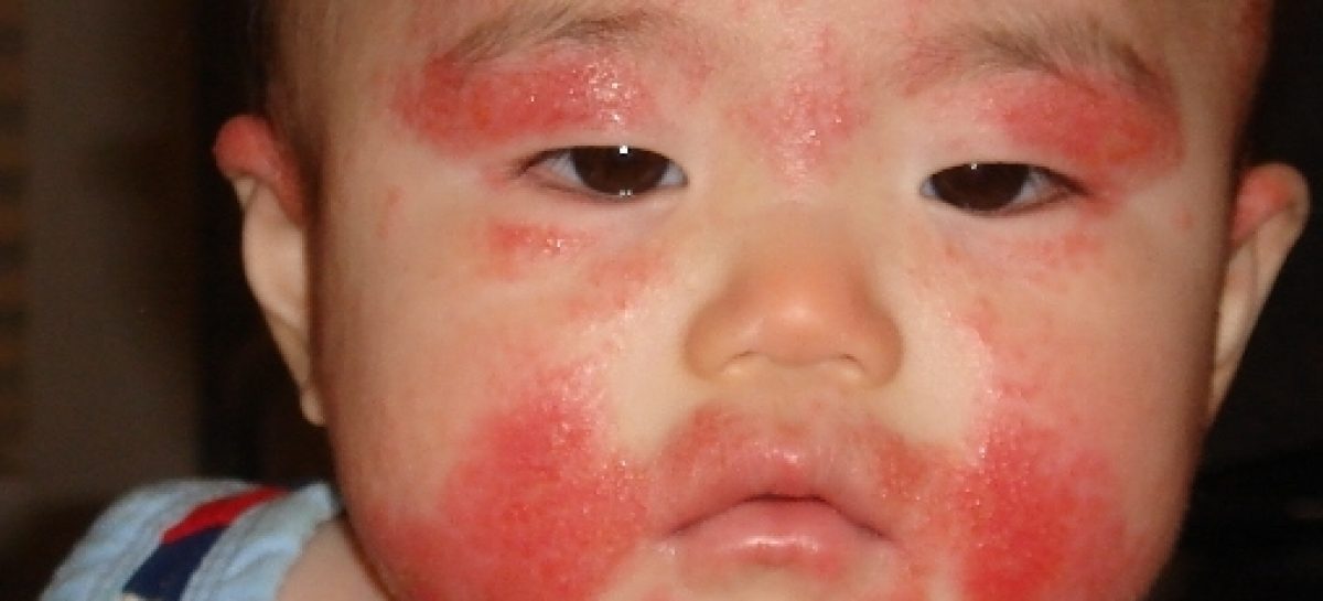 Infant allergies: The types and how to cope with