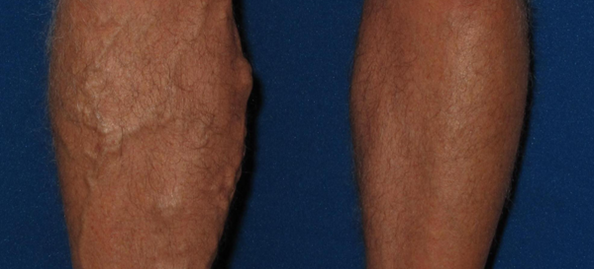 What is varicose vein and how to find the treatment options?