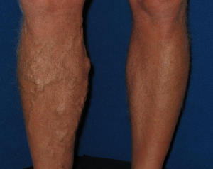 varicose vein