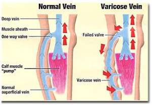 varicose vein1