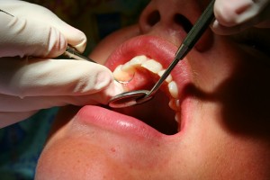 Dental cleaning