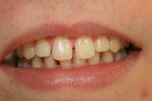 tooth coloured fillings