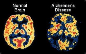 Alzheimers