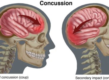 Concussion Rates Are on the Rise for Kid