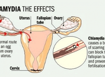 Chlamydia: Symptoms, Treatment And Prevention