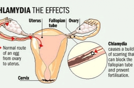 Chlamydia: Symptoms, Treatment And Prevention