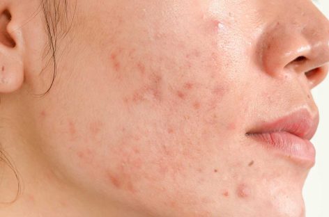 What Can Dermatologists Do For Acne Scars