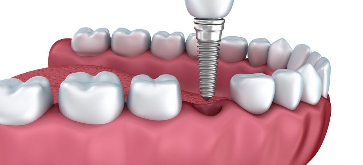 Things You Probably Didn’t Know About Dental Implants