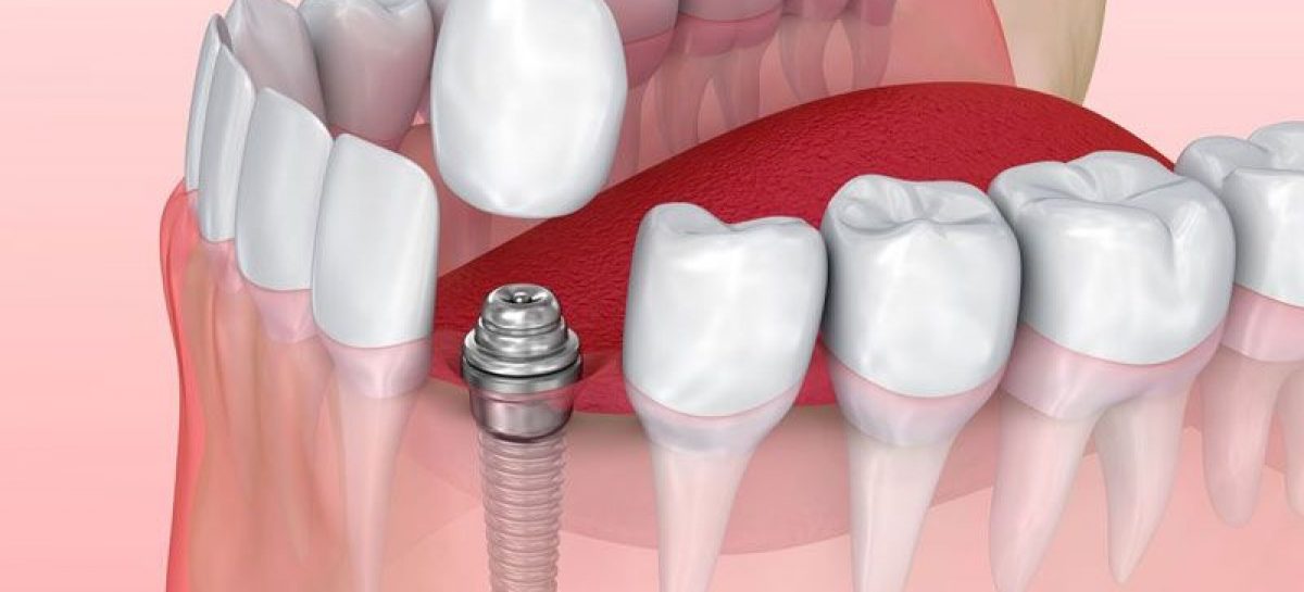 Can You Live Without Dental Implants