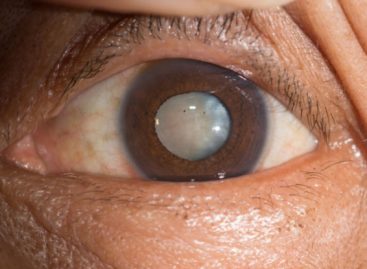 Learn More About These 3 Types of Cataracts