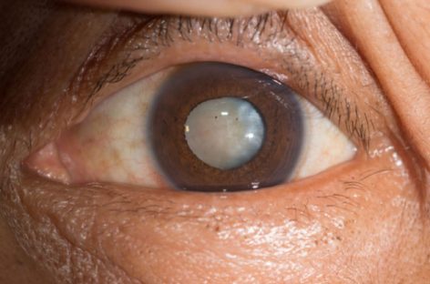 Learn More About These 3 Types of Cataracts