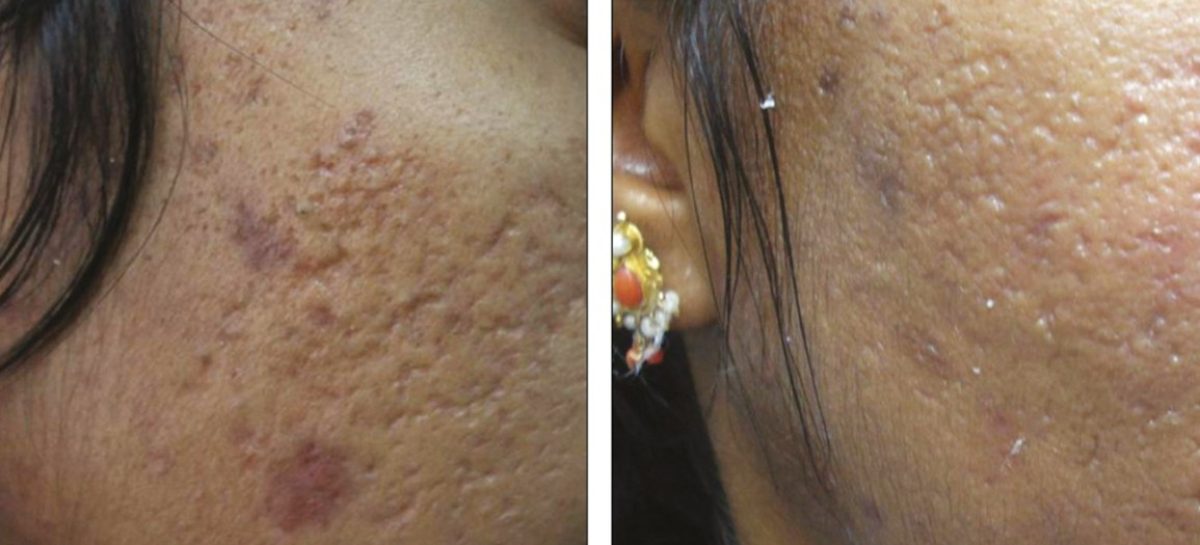 Plastic Surgery For Acne Scars