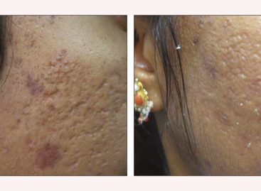 Plastic Surgery For Acne Scars