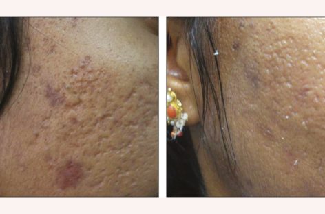 Plastic Surgery For Acne Scars