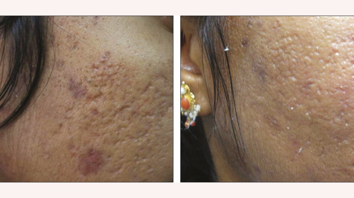 plastic-surgery-for-acne-scars-healthy-panacea