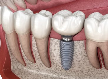 An Effective Solution for a Brighter Smile: Dental Implants