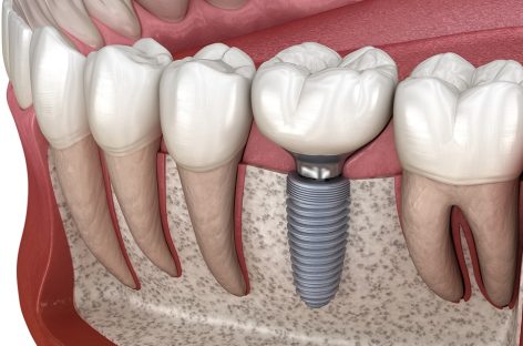 An Effective Solution for a Brighter Smile: Dental Implants